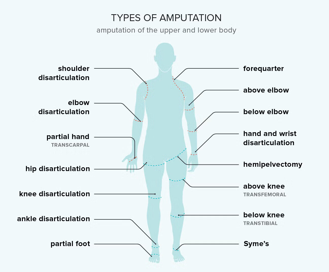 amputation 1296x1168 body